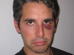 xaxaxa 070 black eye.jpg